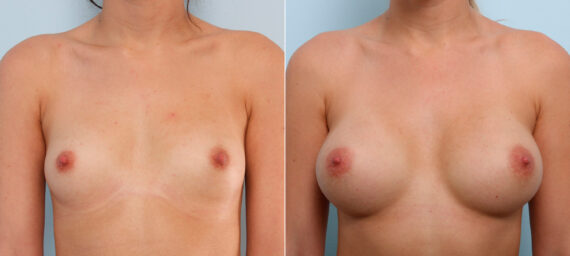 Breast Augmentation before and after photos in Houston, TX, Patient 41602