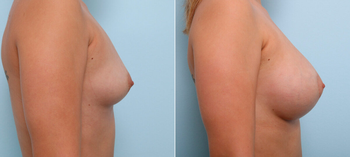Breast Augmentation before and after photos in Houston, TX, Patient 41623