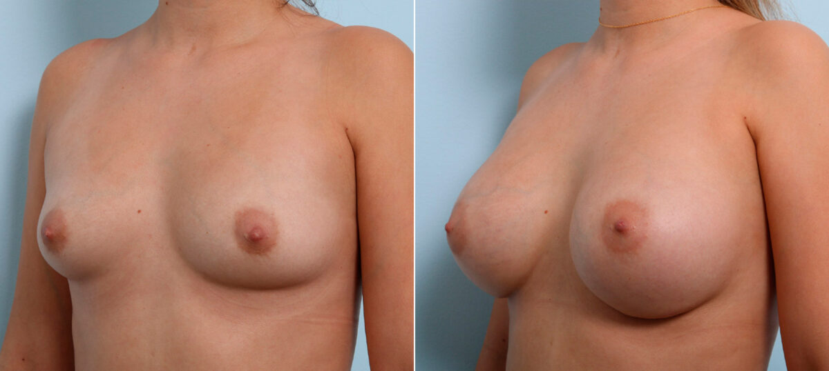 Breast Augmentation before and after photos in Houston, TX, Patient 41623