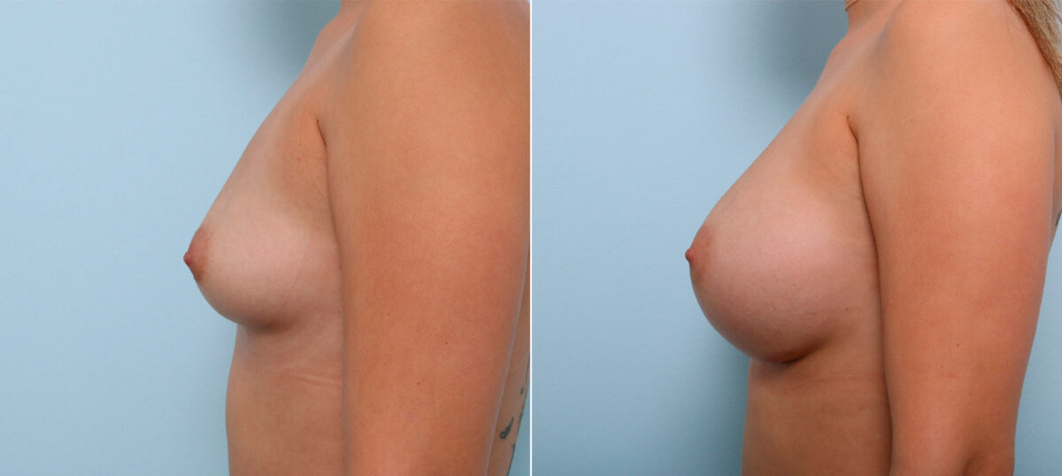 Breast Augmentation before and after photos in Houston, TX, Patient 41623