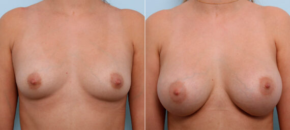 Breast Augmentation before and after photos in Houston, TX, Patient 41623