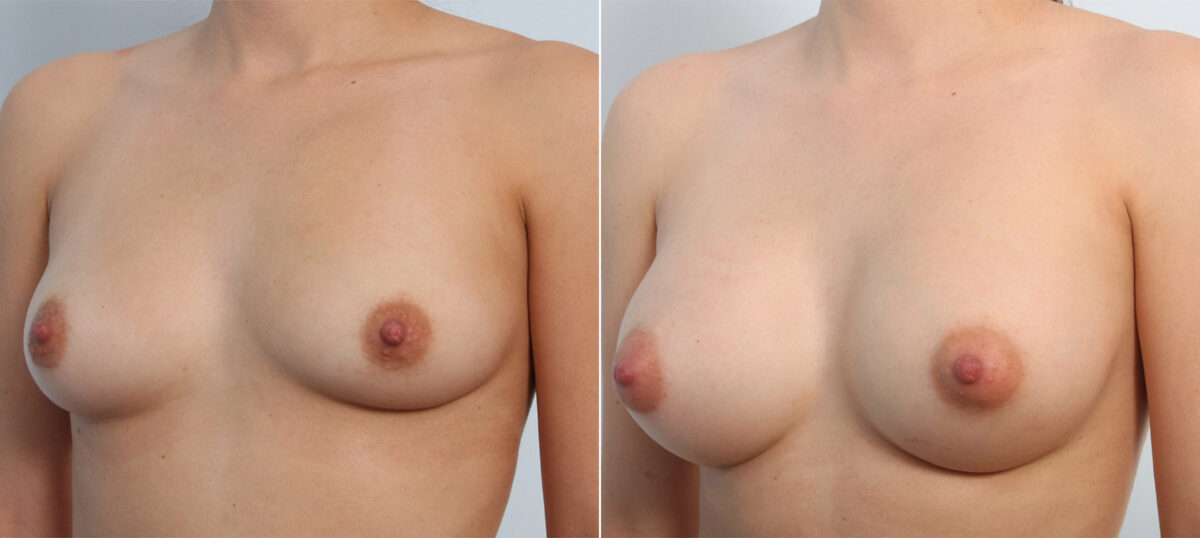 Breast Augmentation before and after photos in Houston, TX, Patient 41644