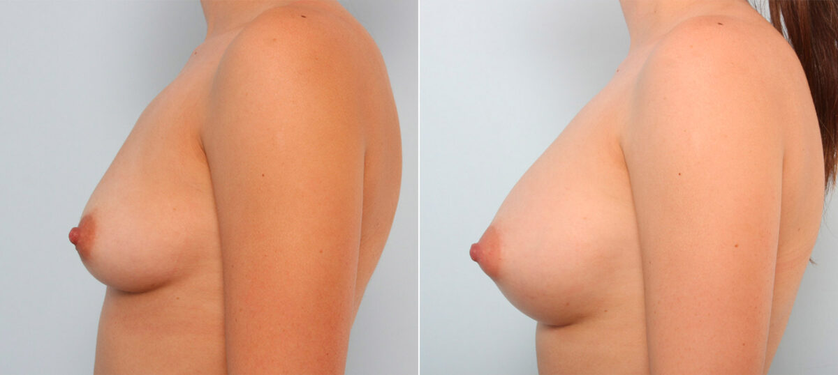 Breast Augmentation before and after photos in Houston, TX, Patient 41644