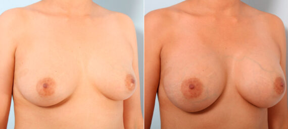 Breast Augmentation before and after photos in Houston, TX, Patient 41707