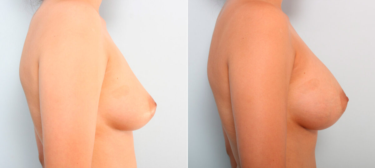 Breast Augmentation before and after photos in Houston, TX, Patient 41707