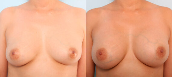 Breast Augmentation before and after photos in Houston, TX, Patient 41707