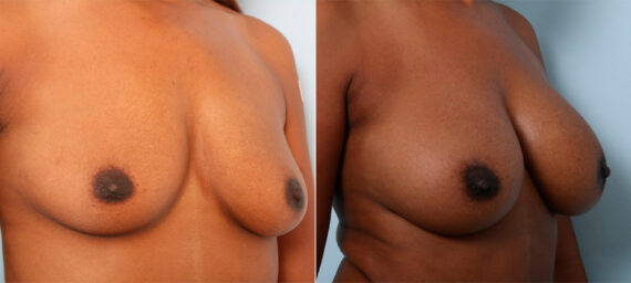 Breast Augmentation before and after photos in Houston, TX, Patient 41728