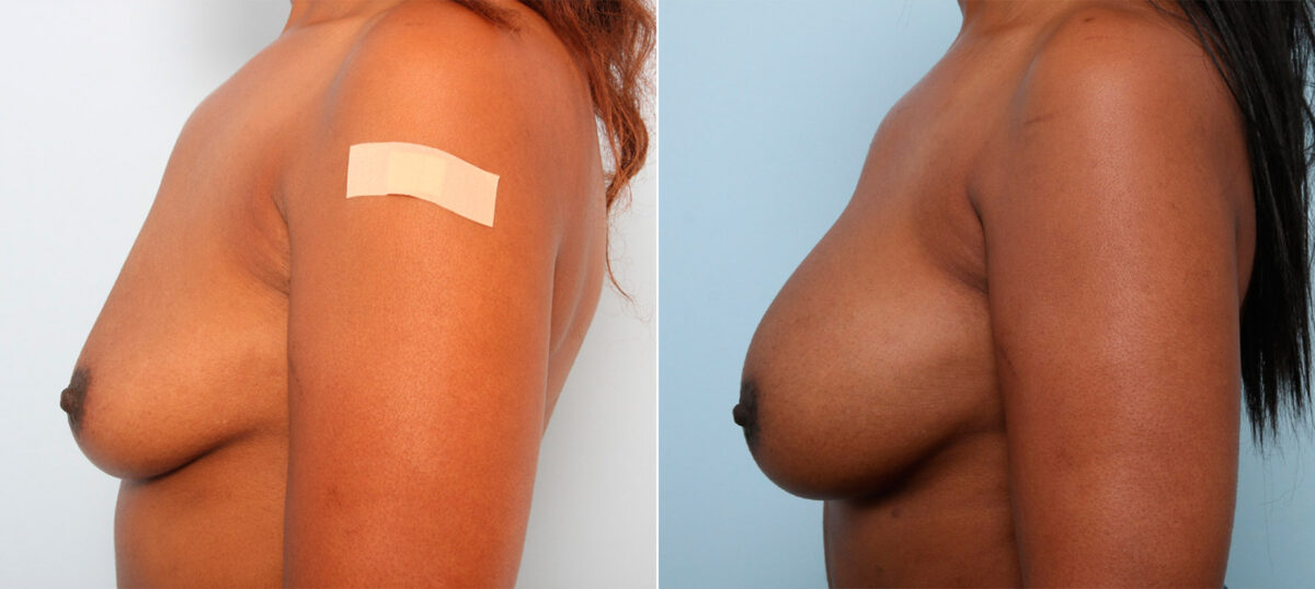 Breast Augmentation before and after photos in Houston, TX, Patient 41728