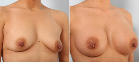 Breast Augmentation before and after photos in Houston, TX, Patient 41749