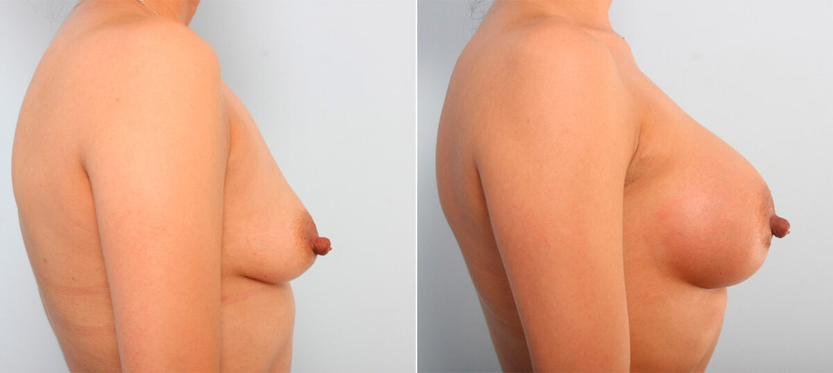 Breast Augmentation before and after photos in Houston, TX, Patient 41749