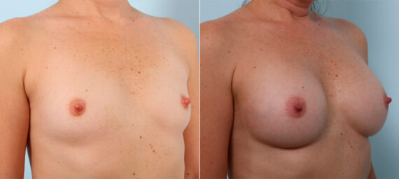 Breast Augmentation before and after photos in Houston, TX, Patient 41771