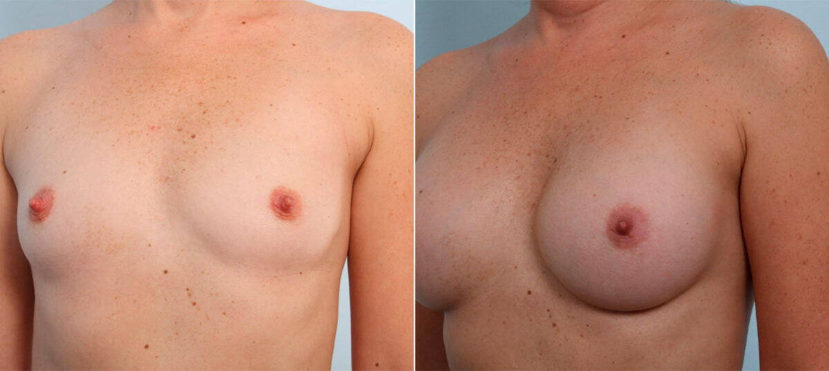 Breast Augmentation before and after photos in Houston, TX, Patient 41771