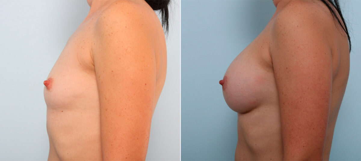 Breast Augmentation before and after photos in Houston, TX, Patient 41771