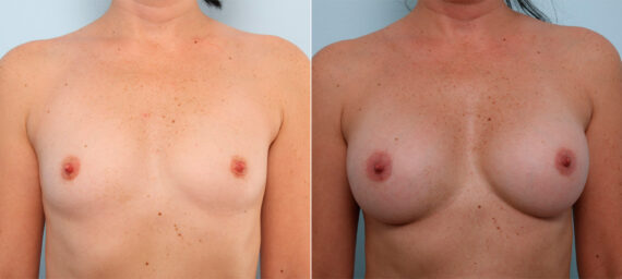 Breast Augmentation before and after photos in Houston, TX, Patient 41771