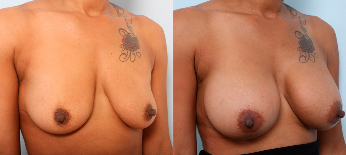 Breast Augmentation before and after photos in Houston, TX, Patient 41794