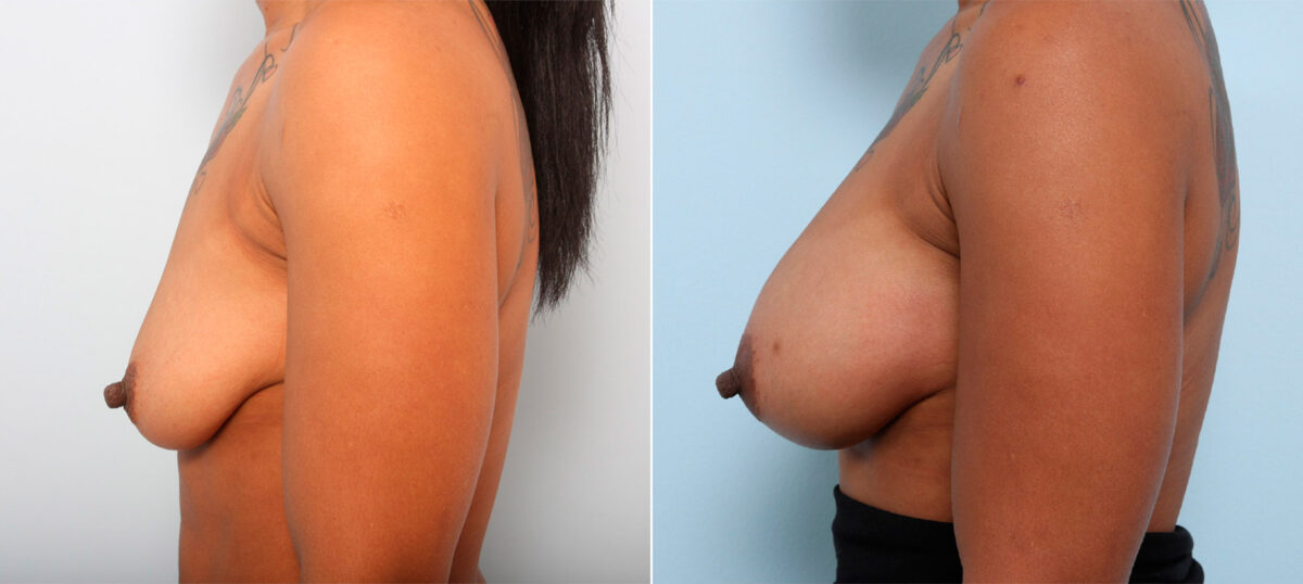 Breast Augmentation before and after photos in Houston, TX, Patient 41794