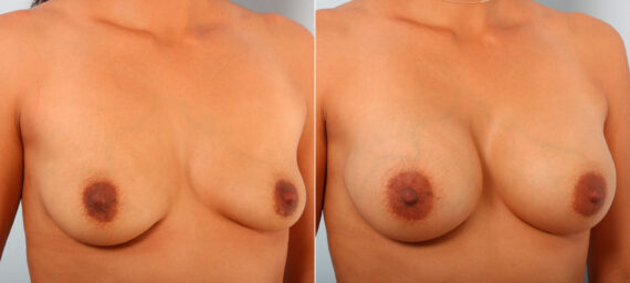 Breast Augmentation before and after photos in Houston, TX, Patient 41815
