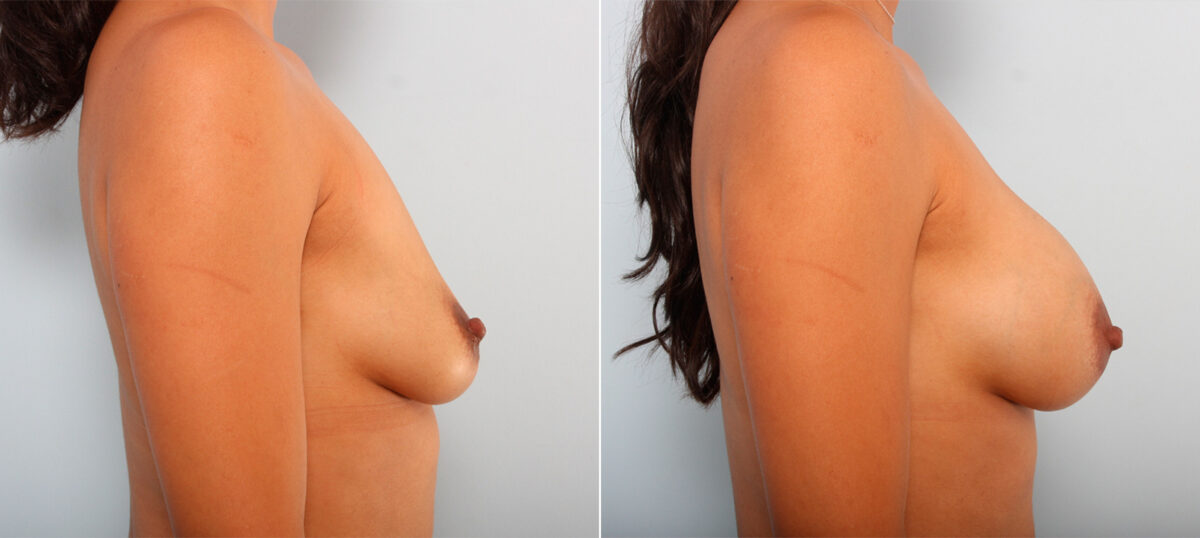Breast Augmentation before and after photos in Houston, TX, Patient 41815