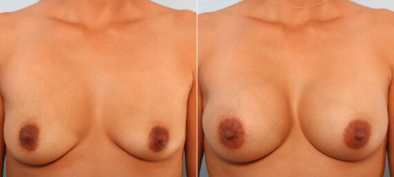 Breast Augmentation before and after photos in Houston, TX, Patient 41815