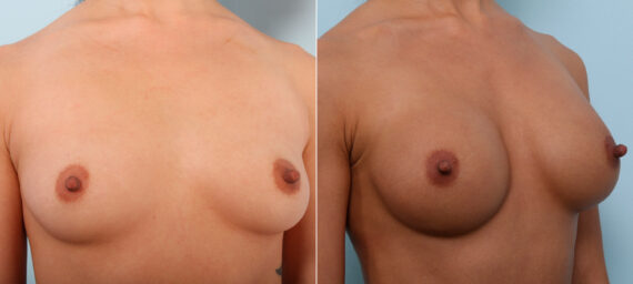 Breast Augmentation before and after photos in Houston, TX, Patient 41836