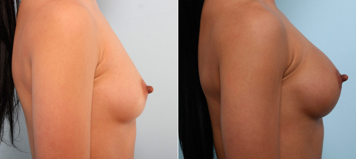 Breast Augmentation before and after photos in Houston, TX, Patient 41836