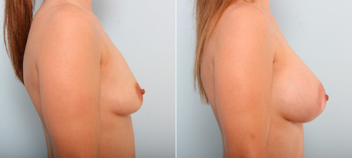 Breast Augmentation before and after photos in Houston, TX, Patient 41857