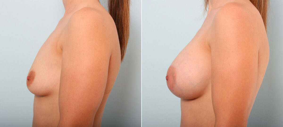 Breast Augmentation before and after photos in Houston, TX, Patient 41857