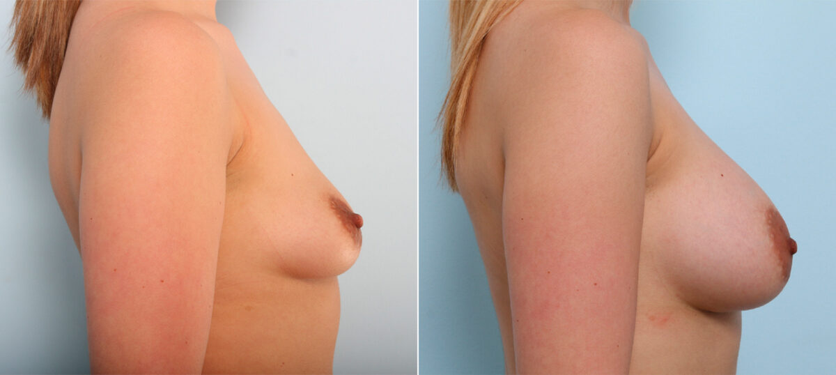 Breast Augmentation before and after photos in Houston, TX, Patient 41878