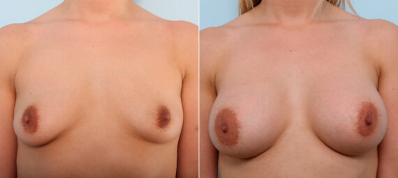 Breast Augmentation before and after photos in Houston, TX, Patient 41878