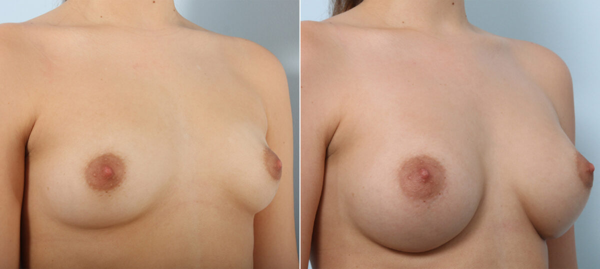 Breast Augmentation before and after photos in Houston, TX, Patient 41899