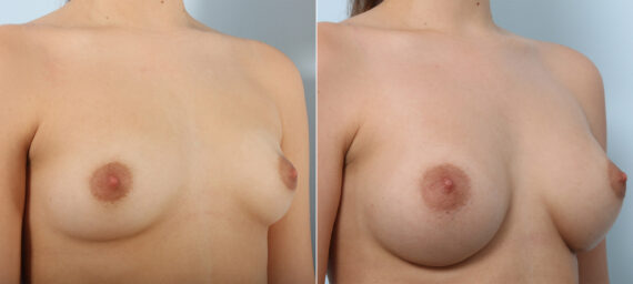 Breast Augmentation before and after photos in Houston, TX, Patient 41899
