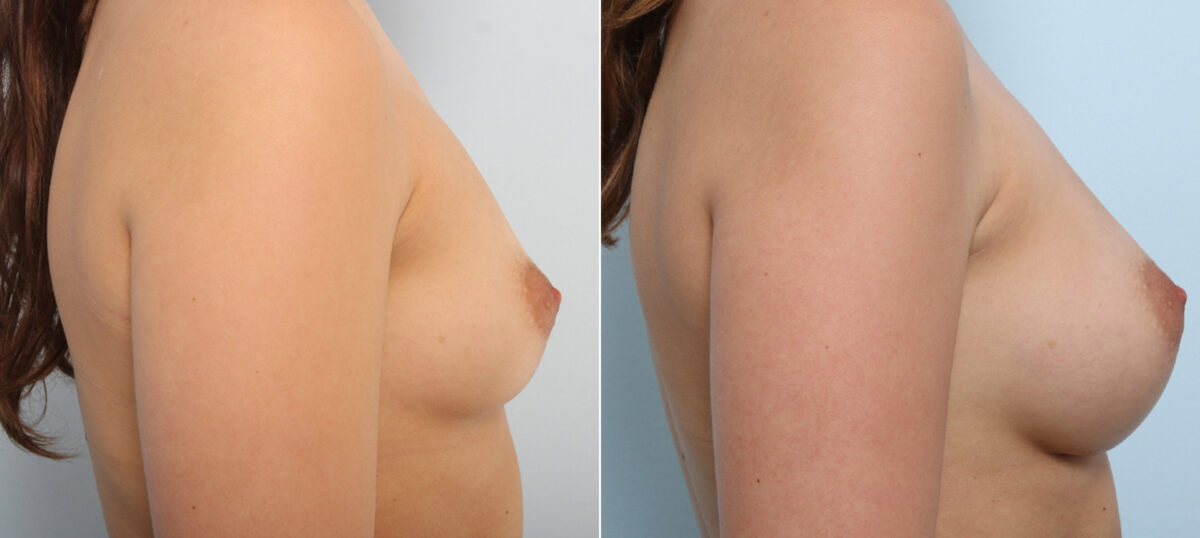 Breast Augmentation before and after photos in Houston, TX, Patient 41899