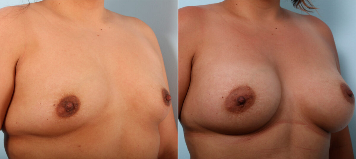 Breast Augmentation before and after photos in Houston, TX, Patient 41920