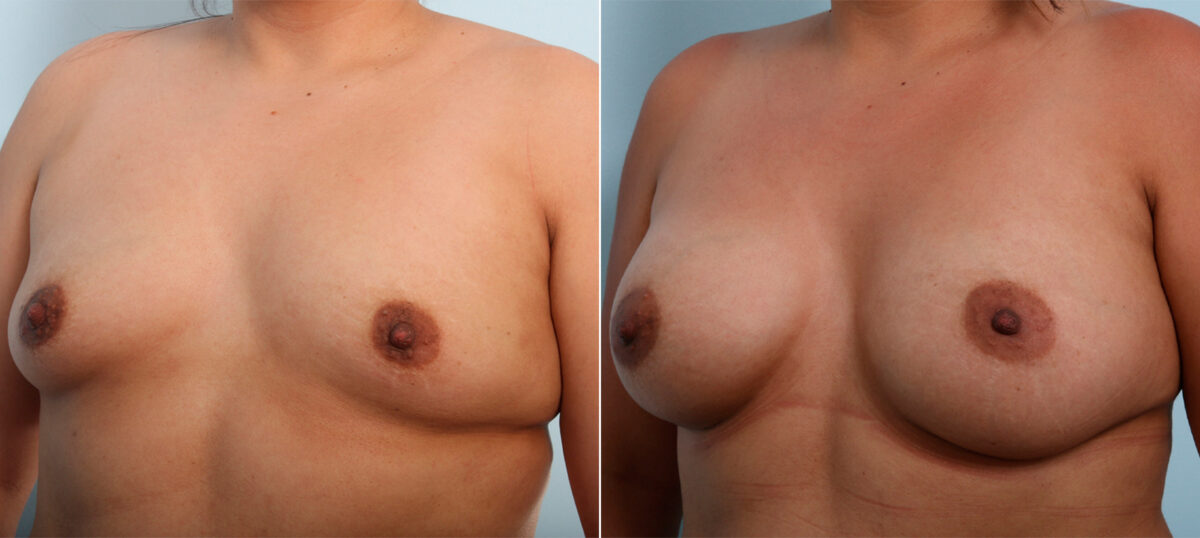 Breast Augmentation before and after photos in Houston, TX, Patient 41920