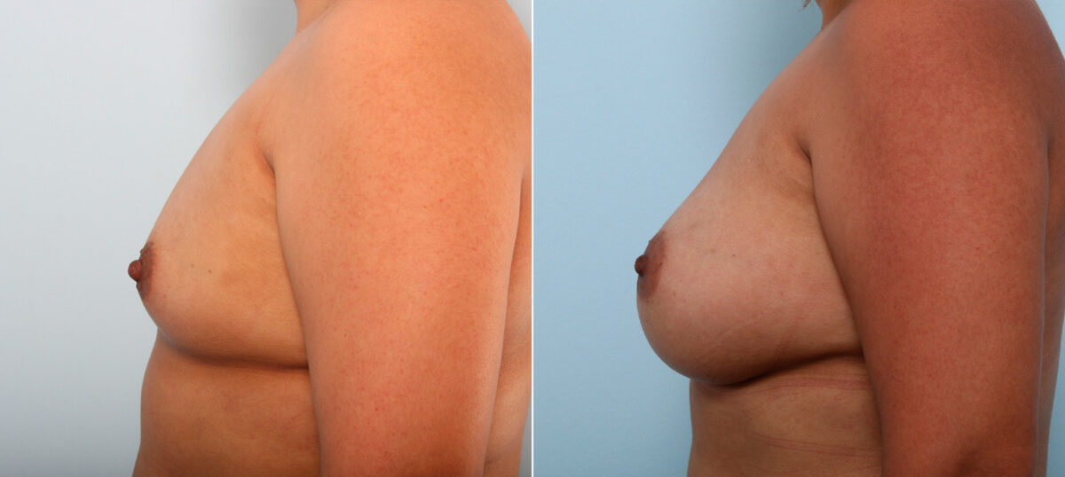 Breast Augmentation before and after photos in Houston, TX, Patient 41920