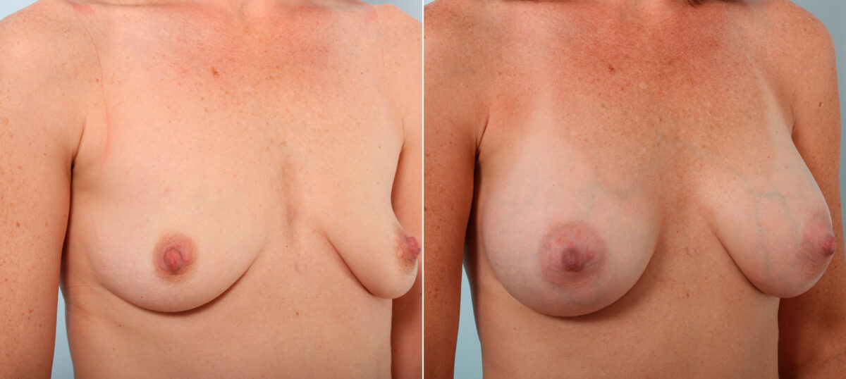Breast Augmentation before and after photos in Houston, TX, Patient 41941