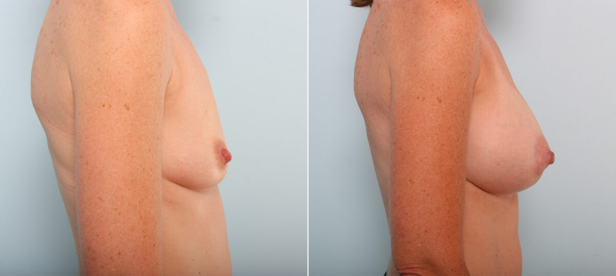 Breast Augmentation before and after photos in Houston, TX, Patient 41941