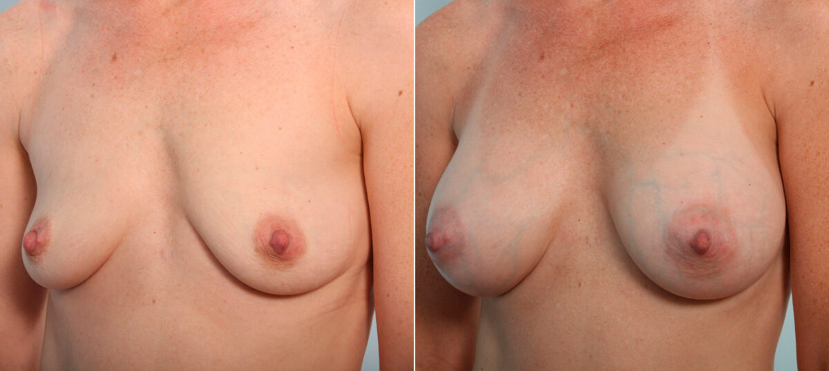 Breast Augmentation before and after photos in Houston, TX, Patient 41941