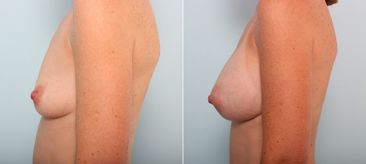 Breast Augmentation before and after photos in Houston, TX, Patient 41941