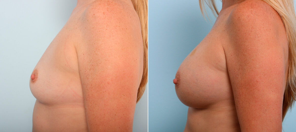 Breast Augmentation before and after photos in Houston, TX, Patient 41983