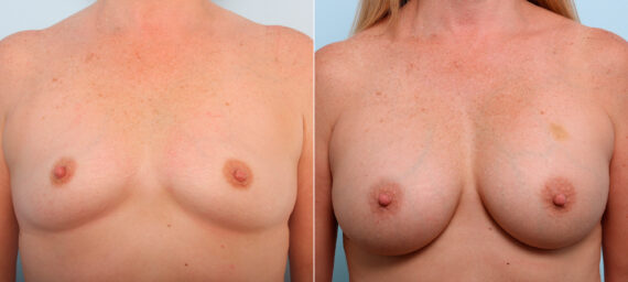 Breast Augmentation before and after photos in Houston, TX, Patient 41983