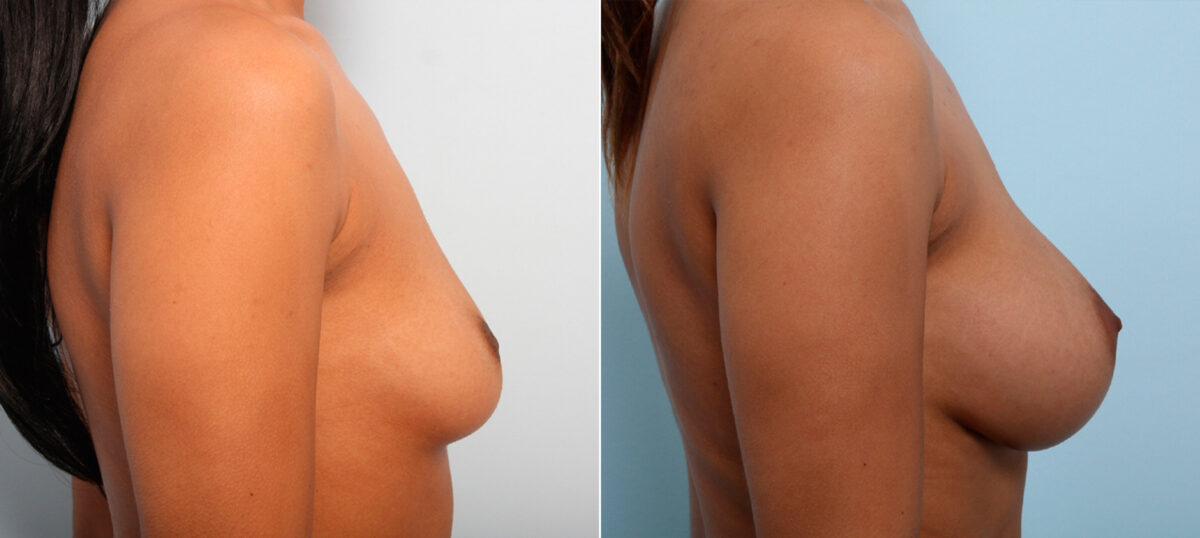 Breast Augmentation before and after photos in Houston, TX, Patient 42004