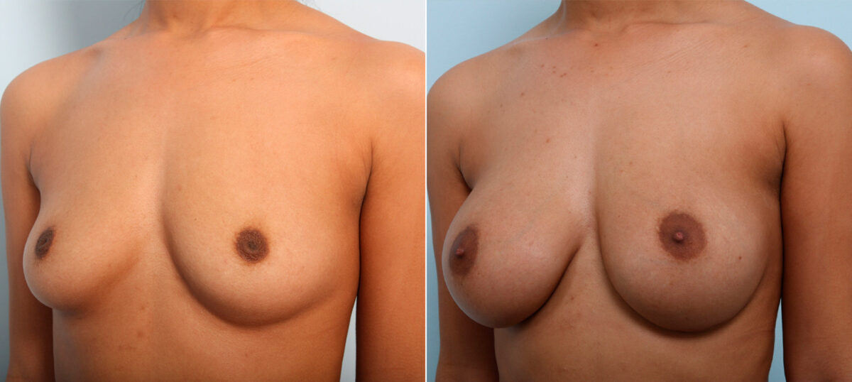 Breast Augmentation before and after photos in Houston, TX, Patient 42004