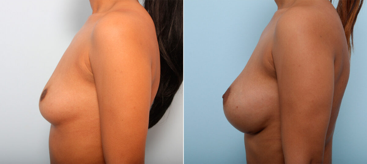 Breast Augmentation before and after photos in Houston, TX, Patient 42004
