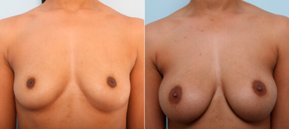 Breast Augmentation before and after photos in Houston, TX, Patient 42004