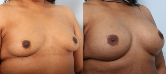 Breast Augmentation before and after photos in Houston, TX, Patient 42025