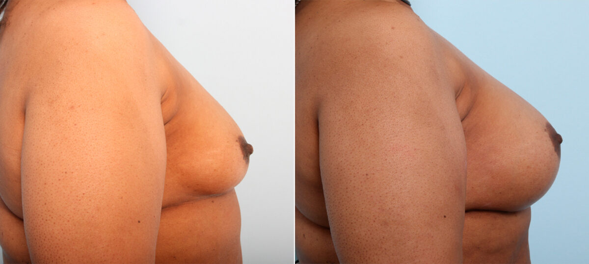 Breast Augmentation before and after photos in Houston, TX, Patient 42025