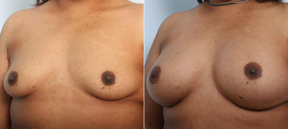 Breast Augmentation before and after photos in Houston, TX, Patient 42025