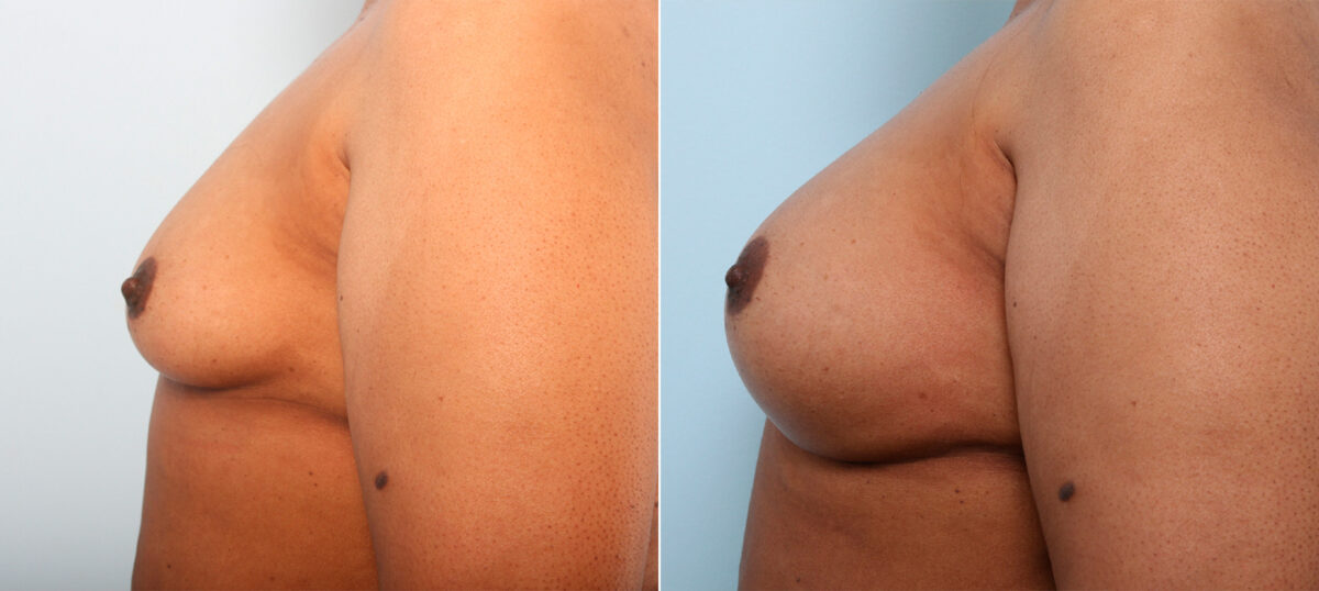 Breast Augmentation before and after photos in Houston, TX, Patient 42025