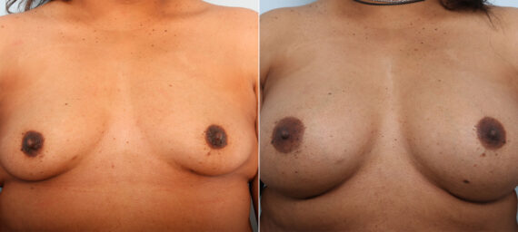 Breast Augmentation before and after photos in Houston, TX, Patient 42025